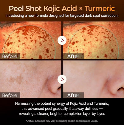 Peel Shot Kojic Acid Turmeric Serum (80ml)